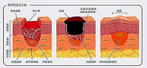 為什么傷口愈合時(shí)會(huì)感覺癢,傷口愈合特別癢怎么辦