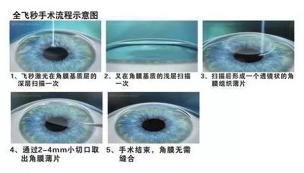 人為什么會(huì)近視,近視眼形成的原理是什么